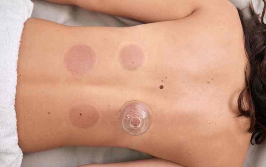 Cupping Is Trending, However Does it Assist Restoration?
